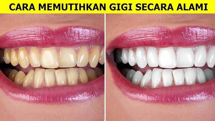 Cara Alami Memutihkan Gigi dengan Mudah dan Aman