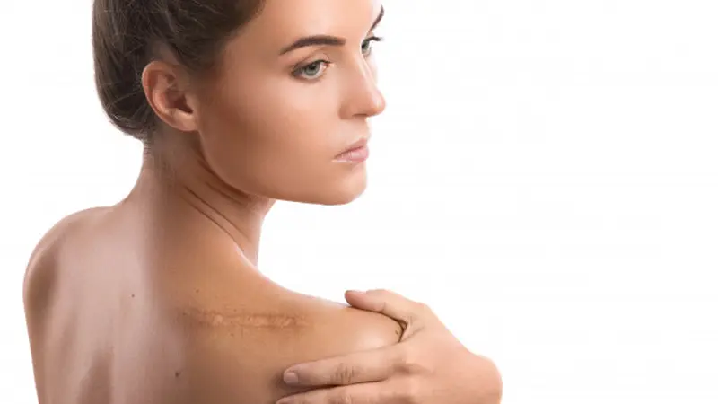 Tips Hilangkan Bekas Luka dengan Efektif untuk Kulit Mulus Sehat