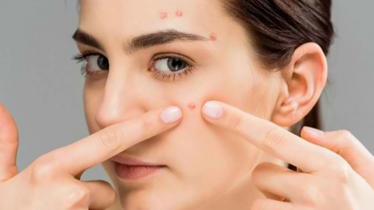 Hindari Kebiasaan Memencet Jerawat Bahaya Bagi Kulit Wajah
