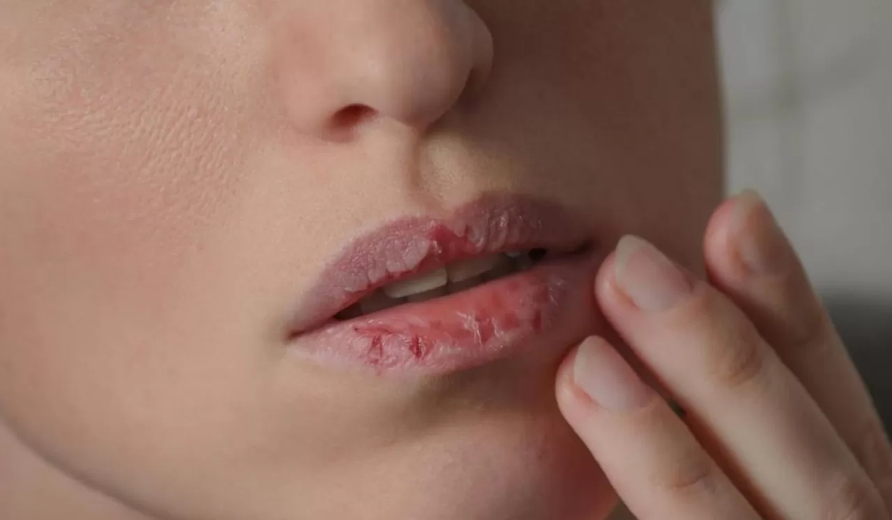 Tips Melembapkan Bibir Kering untuk Rahasia Bibir Sehat