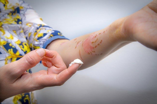 Cara Ampuh Menghilangkan Bekas Luka Agar Kulit Mulus Kembali