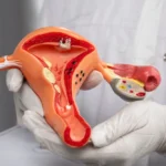 Cara Mencegah Kanker Serviks