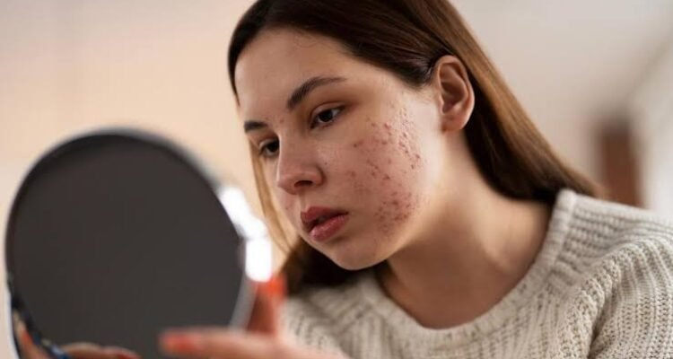 Mengatasi Wajah Bruntusan dengan Tepat dan Aman